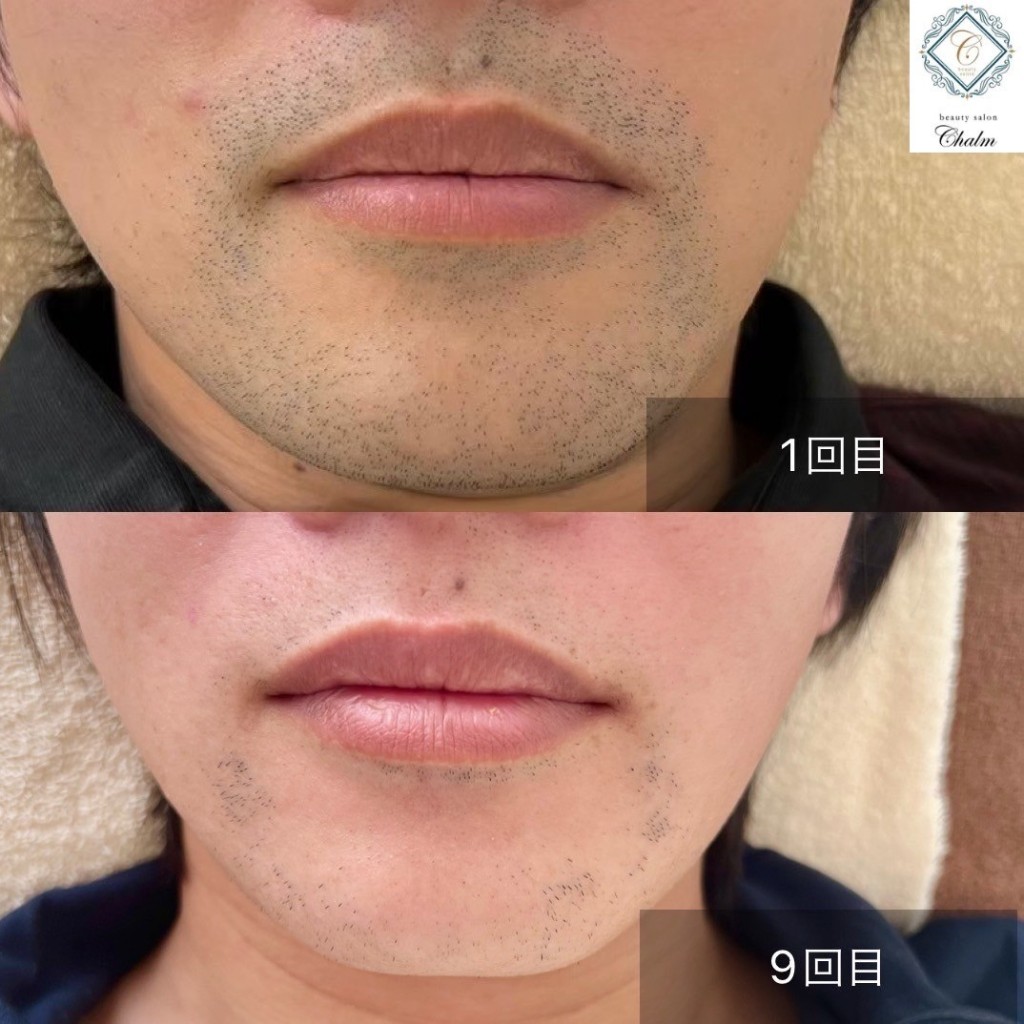 光脱毛 ビフォーアフター